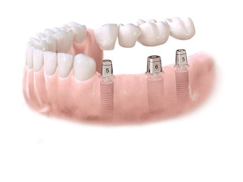 Implant Retained Dentures Augusta GA 30912